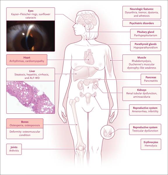 wilson_disease_manifestations.jpg wilson_disease_manifestations.jpg