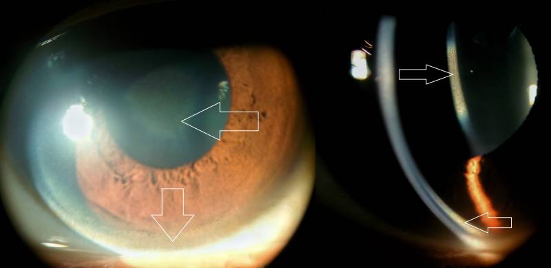 kf_ring_and_sunflower_cataract.jpg kf_ring_and_sunflower_cataract.jpg