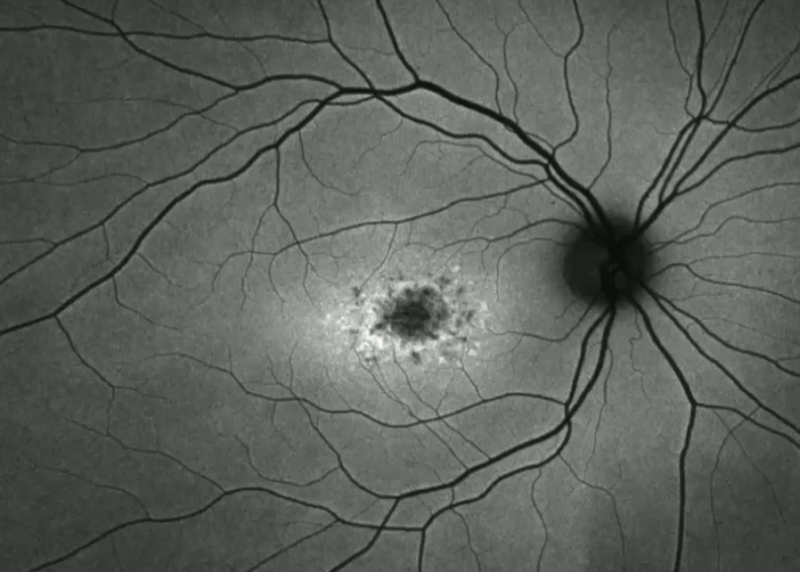 stargardt_dz_fundus_autofl1.png stargardt_dz_fundus_autofl1.png