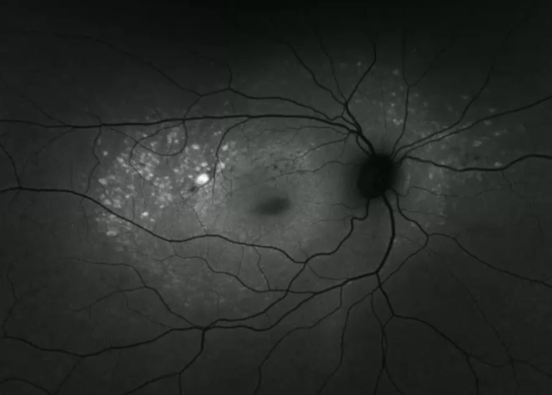 stargardt_dz_fundus_autofl2.png stargardt_dz_fundus_autofl2.png